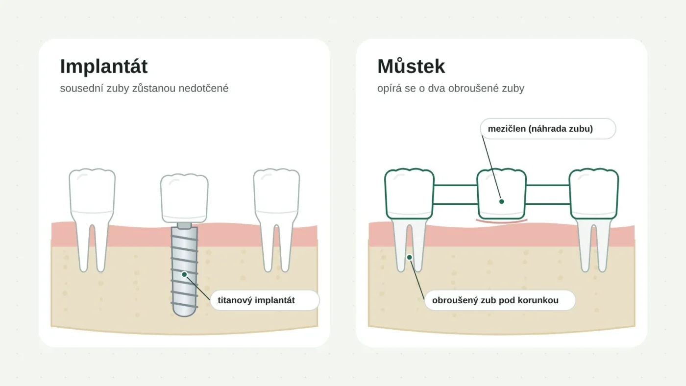 Srovnání zubního implantátu a třídílného můstku