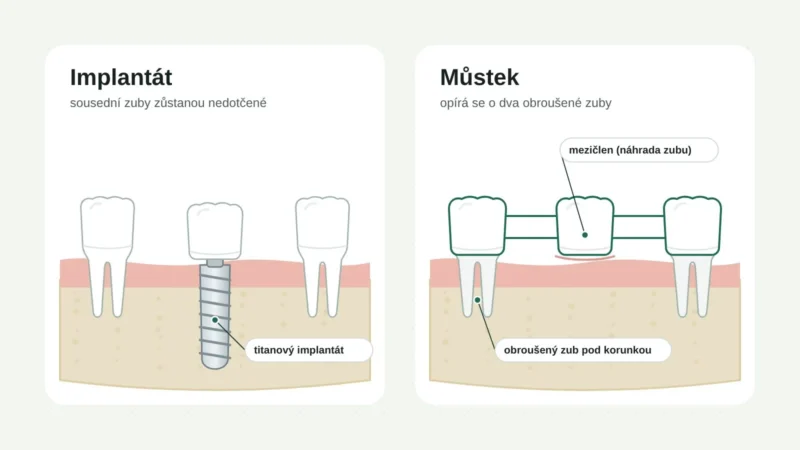 Srovnání zubního implantátu a třídílného můstku
