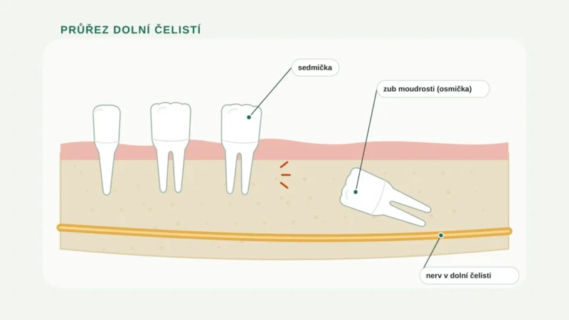 Průřez dolní čelistí se zadrženým zubem moudrosti u nervu