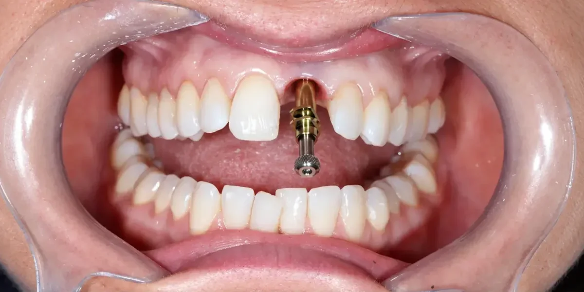 Před: Zubní implantát