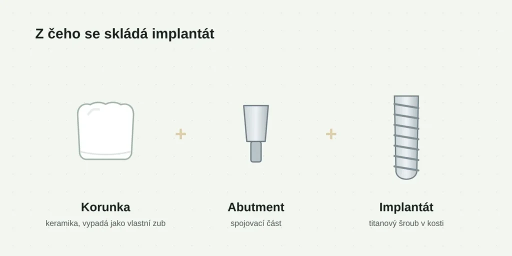 Implantát se skládá ze tří částí: titanového šroubu, abutmentu a korunky